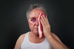 Γιατί οι άνθρωποι βάζουν ωμή μπριζόλα σε ένα μαυρισμένο μάτι;