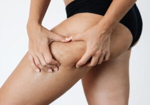 Είναι αποτελεσματικές οι κρέμες για την κυτταρίτιδα; Η άποψη της επιστήμης