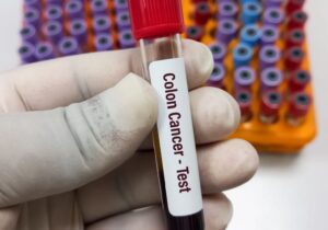 ΗΠΑ: Ελπιδοφόρα έγκριση για εξέταση αίματος που ανιχνεύει τον καρκίνο του παχέος εντέρου