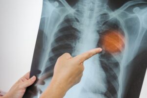 ΗΠΑ: Σε εξέλιξη μία από τις μεγαλύτερες επιδημίες φυματίωσης στην ιστορία