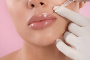 Fillers χειλιών: Πώς επηρεάζουν τα δόντια και την υγεία τους