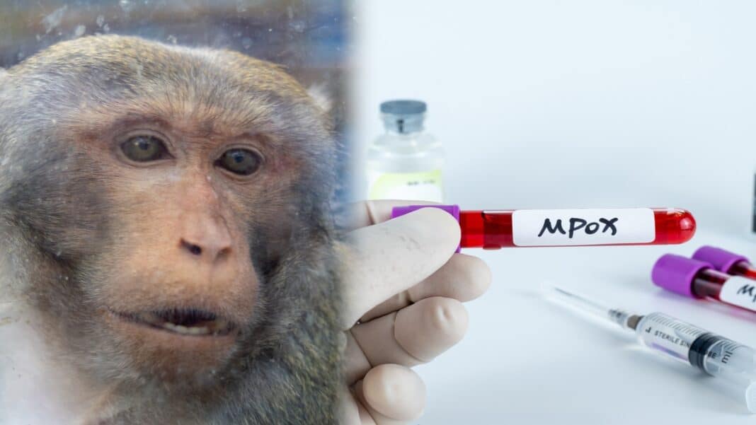 Πρώτο κρούσμα mpox για το 2026 στην Ελλάδα - 45χρονος νοσηλεύεται σε απομόνωση στα Ιωάννινα