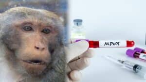 Πρώτο κρούσμα mpox για το 2026 στην Ελλάδα - 45χρονος νοσηλεύεται σε απομόνωση στα Ιωάννινα